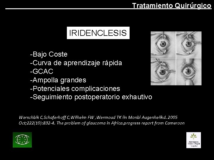 Tratamiento Quirúrgico IRIDENCLESIS -Bajo Coste -Curva de aprendizaje rápida -GCAC -Ampolla grandes -Potenciales complicaciones