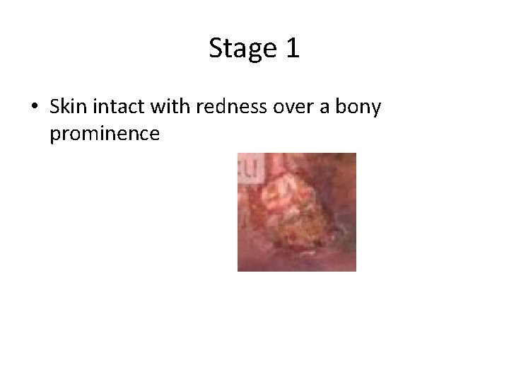 Stage 1 • Skin intact with redness over a bony prominence 