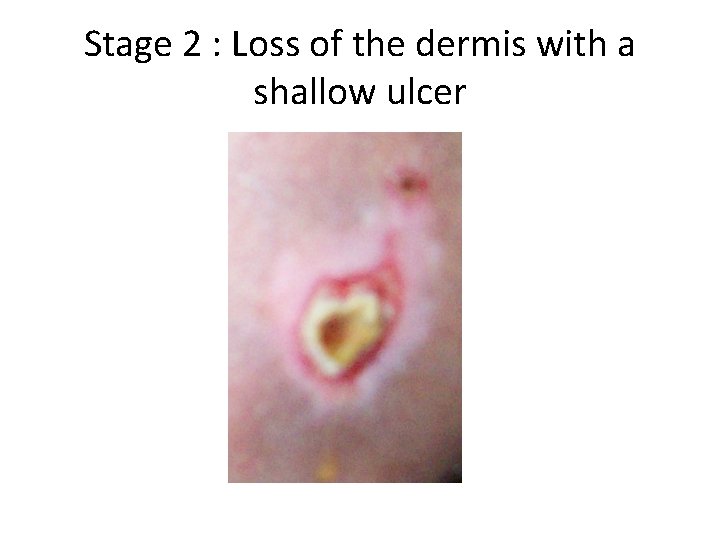 Stage 2 : Loss of the dermis with a shallow ulcer 