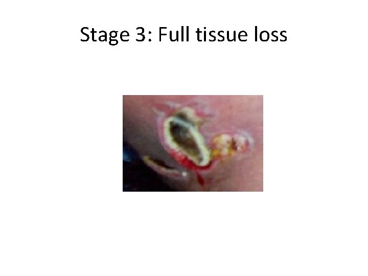 Stage 3: Full tissue loss 