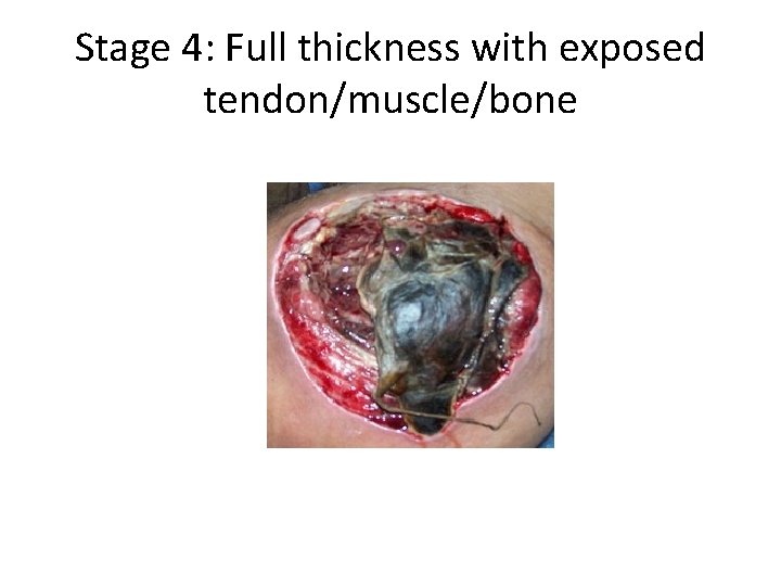 Stage 4: Full thickness with exposed tendon/muscle/bone 