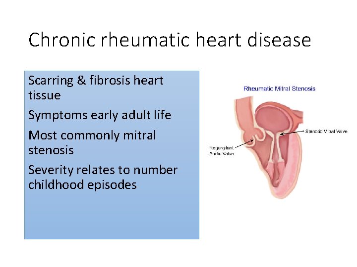 Chronic rheumatic heart disease Scarring & fibrosis heart tissue Symptoms early adult life Most