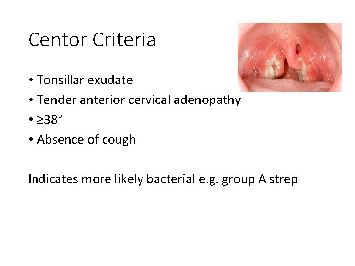 Centor Criteria • Tonsillar exudate • Tender anterior cervical adenopathy • ≥ 38° •