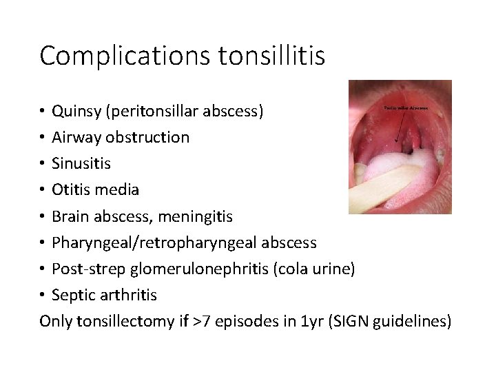 Complications tonsillitis • Quinsy (peritonsillar abscess) • Airway obstruction • Sinusitis • Otitis media