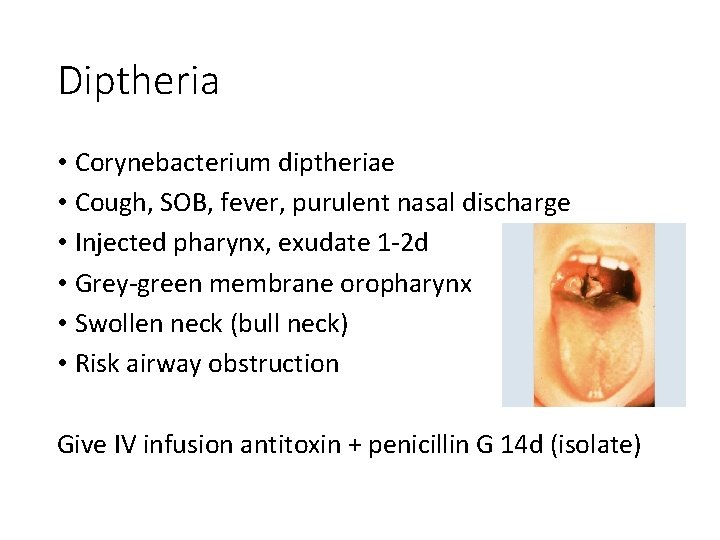Diptheria • Corynebacterium diptheriae • Cough, SOB, fever, purulent nasal discharge • Injected pharynx,