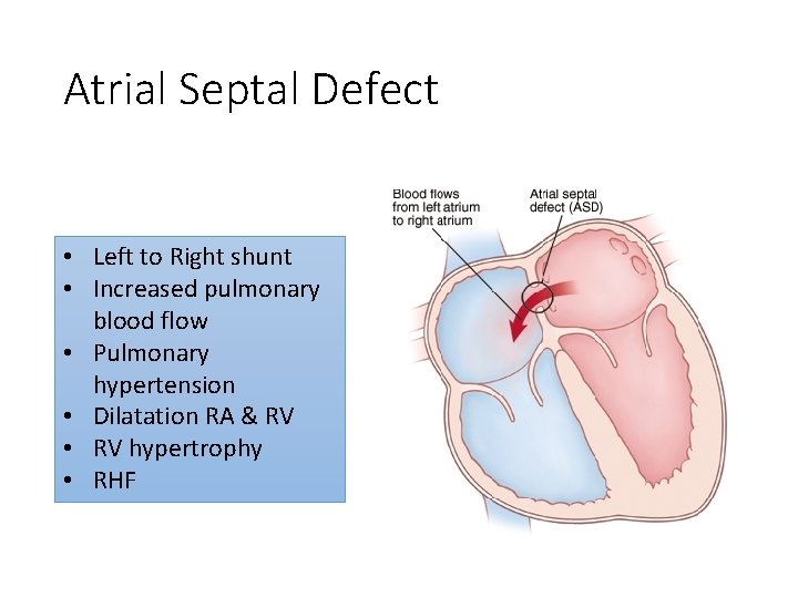 Atrial Septal Defect • Left to Right shunt • Increased pulmonary blood flow •