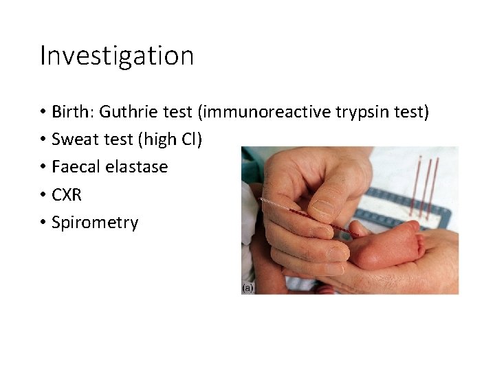 Investigation • Birth: Guthrie test (immunoreactive trypsin test) • Sweat test (high Cl) •