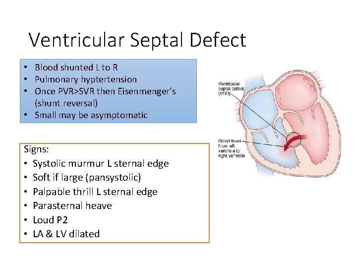 Ventricular Septal Defect • Blood shunted L to R • Pulmonary hyptertension • Once