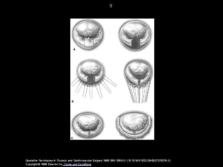 9 Operative Techniques in Thoracic and Cardiovascular Surgery 1998 395 -108 DOI: (10. 1016/S