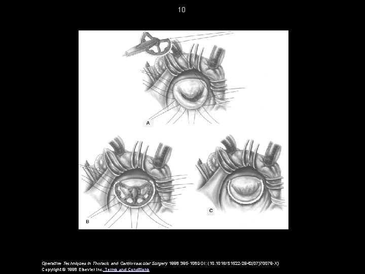 10 Operative Techniques in Thoracic and Cardiovascular Surgery 1998 395 -108 DOI: (10. 1016/S