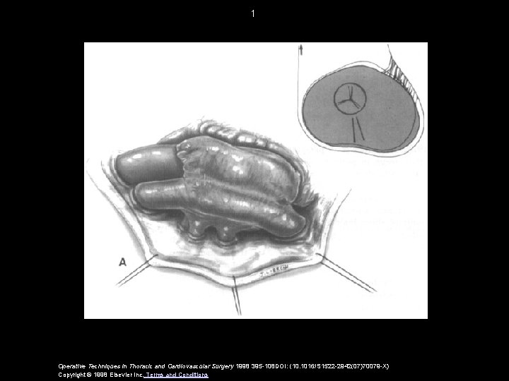1 Operative Techniques in Thoracic and Cardiovascular Surgery 1998 395 -108 DOI: (10. 1016/S 1 Operative Techniques in Thoracic and Cardiovascular Surgery 1998 395 -108 DOI: (10. 1016/S