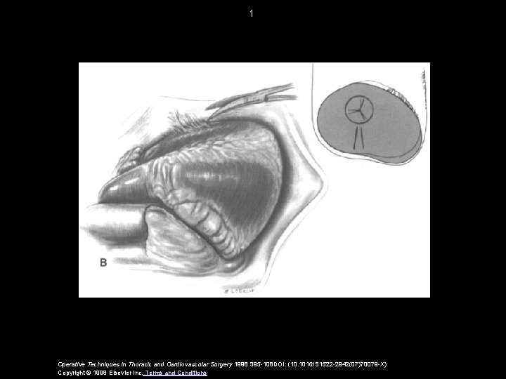 1 Operative Techniques in Thoracic and Cardiovascular Surgery 1998 395 -108 DOI: (10. 1016/S