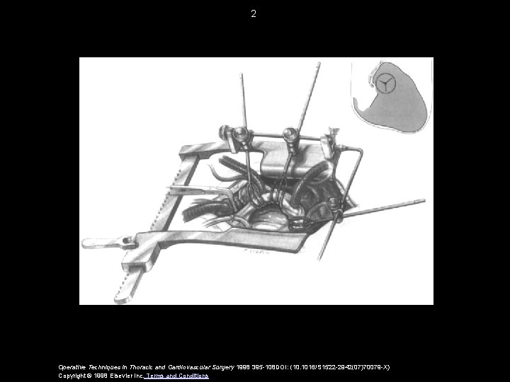 2 Operative Techniques in Thoracic and Cardiovascular Surgery 1998 395 -108 DOI: (10. 1016/S 2 Operative Techniques in Thoracic and Cardiovascular Surgery 1998 395 -108 DOI: (10. 1016/S