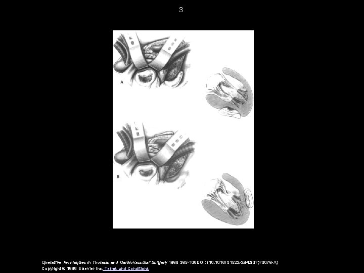 3 Operative Techniques in Thoracic and Cardiovascular Surgery 1998 395 -108 DOI: (10. 1016/S