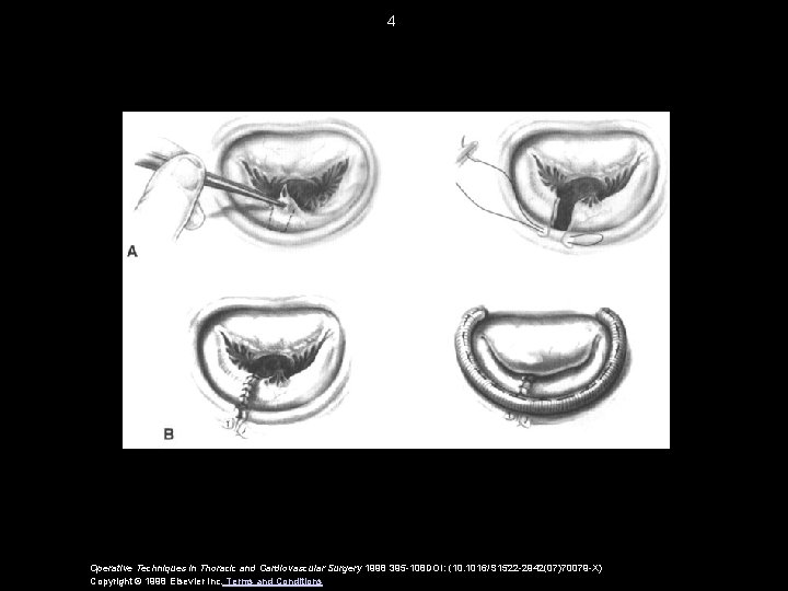 4 Operative Techniques in Thoracic and Cardiovascular Surgery 1998 395 -108 DOI: (10. 1016/S