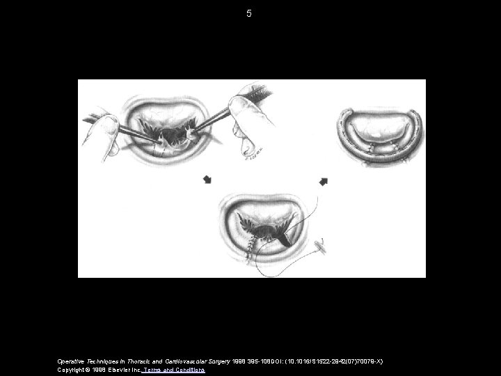 5 Operative Techniques in Thoracic and Cardiovascular Surgery 1998 395 -108 DOI: (10. 1016/S 5 Operative Techniques in Thoracic and Cardiovascular Surgery 1998 395 -108 DOI: (10. 1016/S