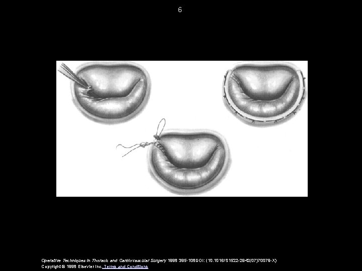 6 Operative Techniques in Thoracic and Cardiovascular Surgery 1998 395 -108 DOI: (10. 1016/S 6 Operative Techniques in Thoracic and Cardiovascular Surgery 1998 395 -108 DOI: (10. 1016/S