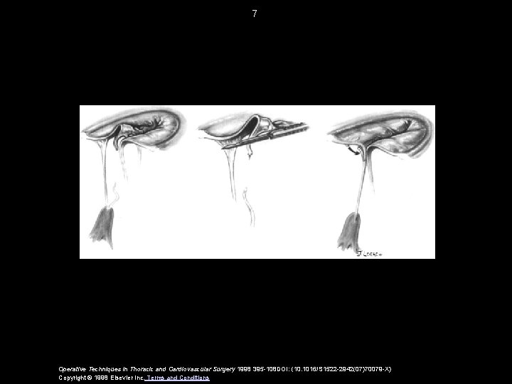 7 Operative Techniques in Thoracic and Cardiovascular Surgery 1998 395 -108 DOI: (10. 1016/S