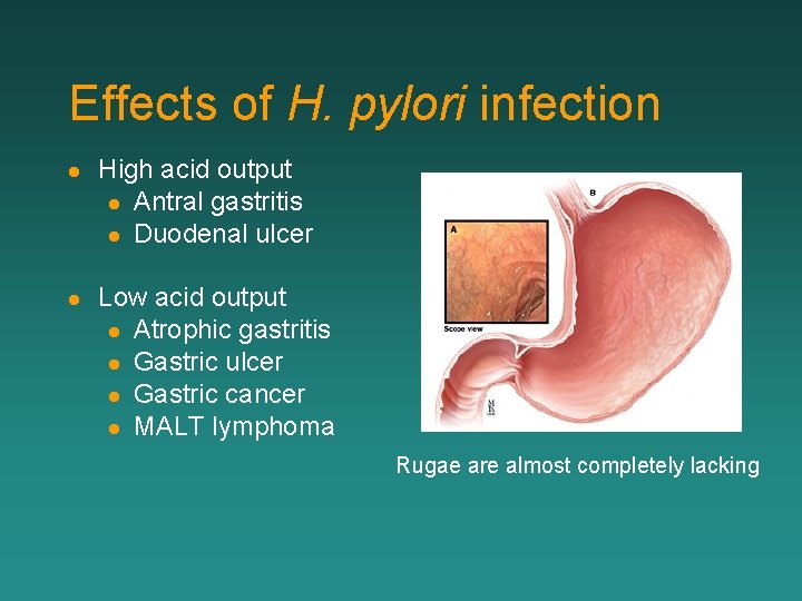 Effects of H. pylori infection l High acid output l Antral gastritis l Duodenal