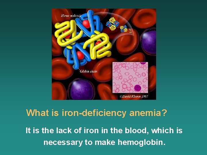 What is iron-deficiency anemia? It is the lack of iron in the blood, which