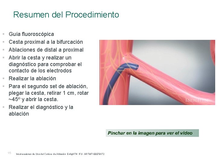 Resumen del Procedimiento § § Guía fluoroscópica Cesta proximal a la bifurcación Ablaciones de