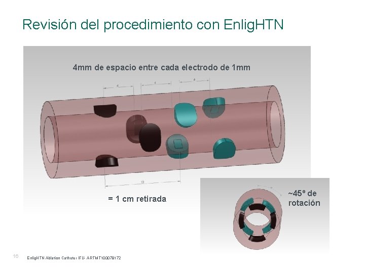 Revisión del procedimiento con Enlig. HTN 4 mm de espacio entre cada electrodo de