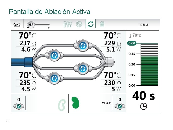 Pantalla de Ablación Activa 17 