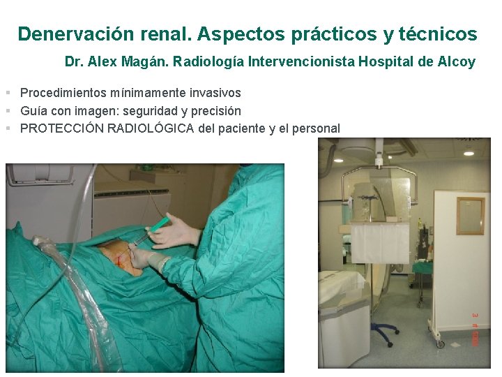 Denervación renal. Aspectos prácticos y técnicos Dr. Alex Magán. Radiología Intervencionista Hospital de Alcoy