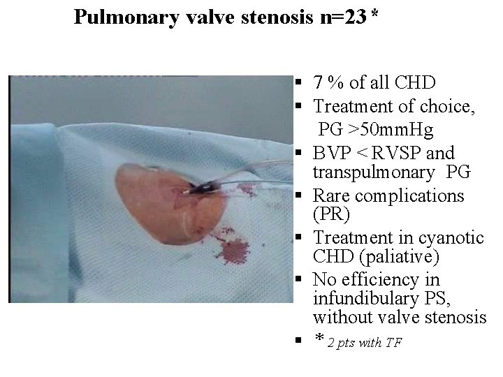 Pulmonary valve stenosis n=23* § 7 % of all CHD § Тreatment of choice,