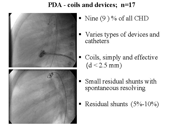 PDA - coils and devices; n=17 § Nine (9 ) % of all CHD