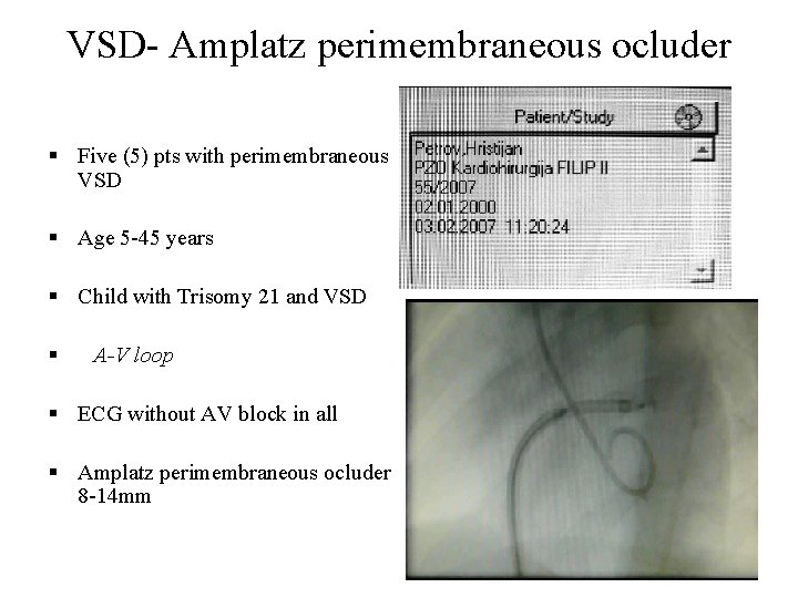 VSD- Amplatz perimembraneous ocluder § Five (5) pts with perimembraneous VSD § Age 5