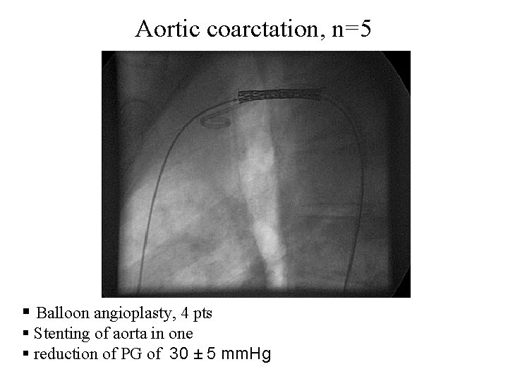 Aortic coarctation, n=5 § Balloon angioplasty, 4 pts § Stenting of aorta in one