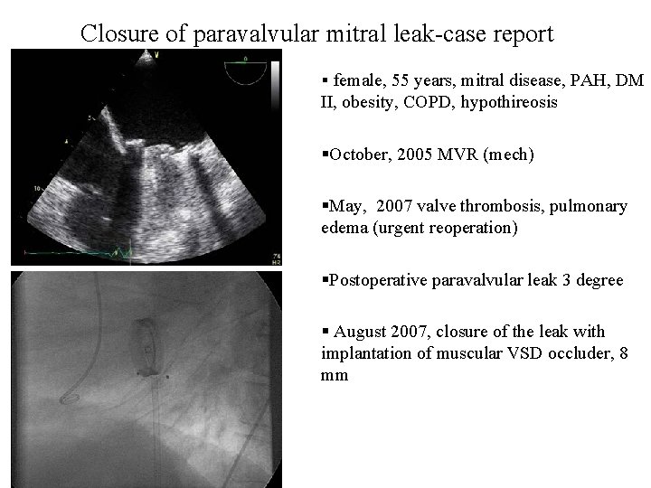 Closure of paravalvular mitral leak-case report § female, 55 years, mitral disease, PAH, DM