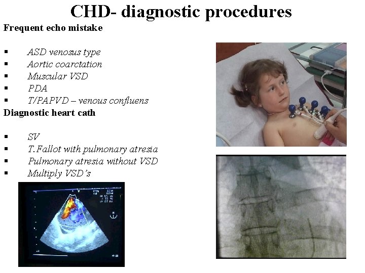 CHD- diagnostic procedures Frequent echo mistake § ASD venosus type § Aortic coarctation §