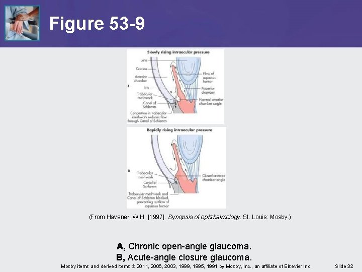 Figure 53 -9 (From Havener, W. H. [1997]. Synopsis of ophthalmology. St. Louis: Mosby.