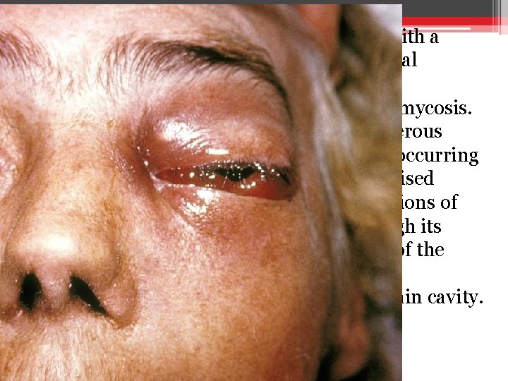  • This patient presented with a case of a periorbital fungal infection known