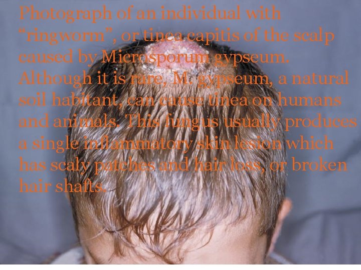 Photograph of an individual with “ringworm”, or tinea capitis of the scalp caused by