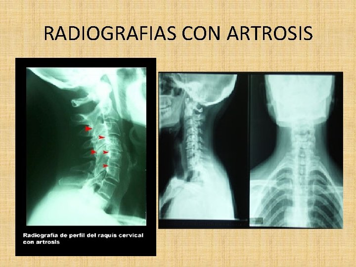  RADIOGRAFIAS CON ARTROSIS 