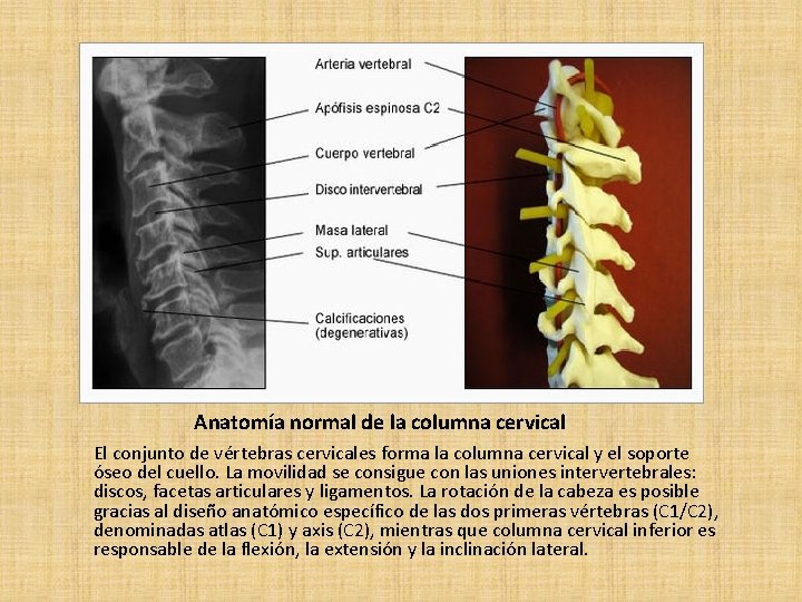 Anatomía normal de la columna cervical El conjunto de vértebras cervicales forma la columna