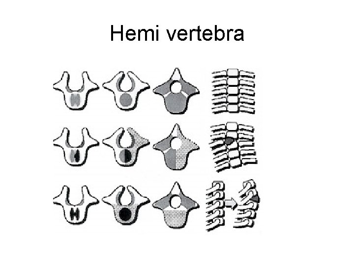 Hemi vertebra 