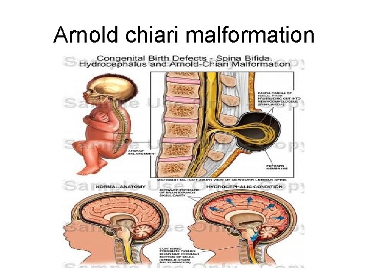 Arnold chiari malformation 