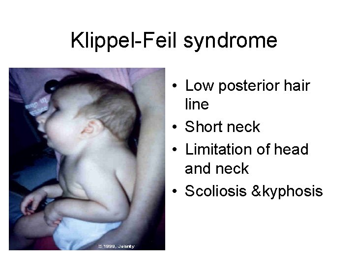 Klippel-Feil syndrome • Low posterior hair line • Short neck • Limitation of head