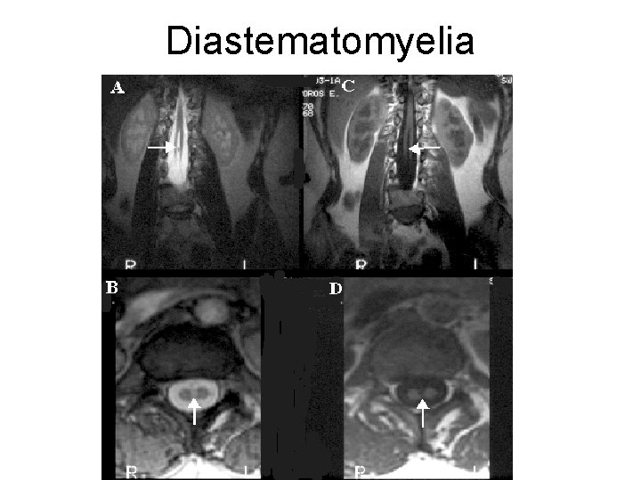 Diastematomyelia 