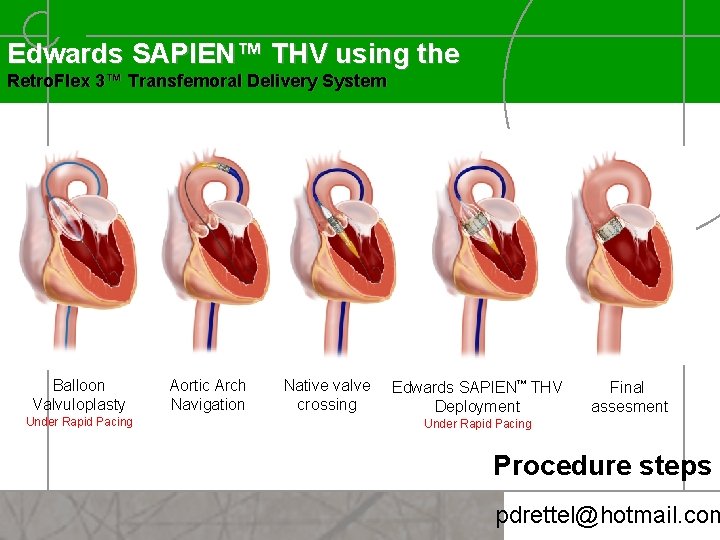 Edwards SAPIEN™ THV using the Retro. Flex 3™ Transfemoral Delivery System Balloon Valvuloplasty Under
