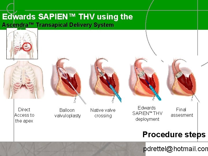 Edwards SAPIEN™ THV using the Ascendra™ Transapical Delivery System Direct Access to the apex