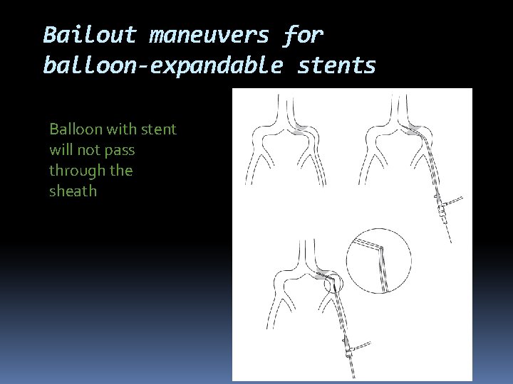 Bailout maneuvers for balloon-expandable stents Balloon with stent will not pass through the sheath
