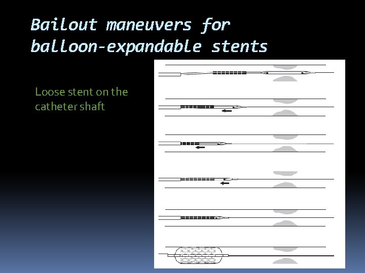 Bailout maneuvers for balloon-expandable stents Loose stent on the catheter shaft 