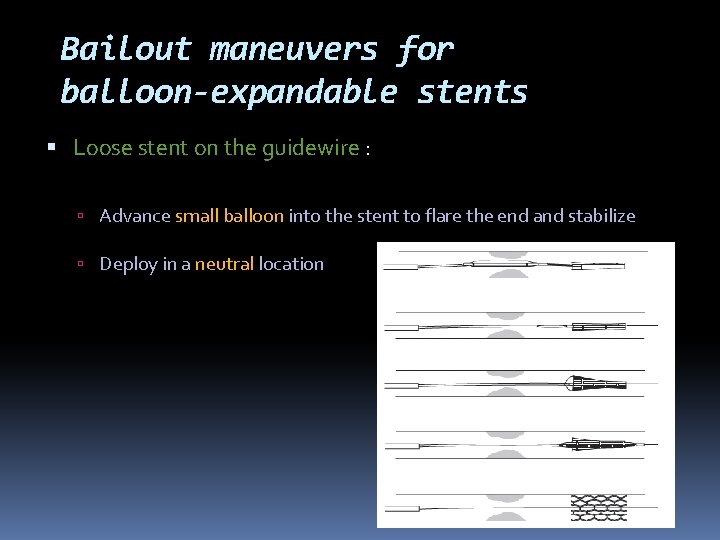 Bailout maneuvers for balloon-expandable stents Loose stent on the guidewire : Advance small balloon