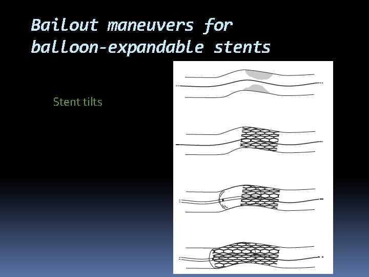 Bailout maneuvers for balloon-expandable stents Stent tilts 
