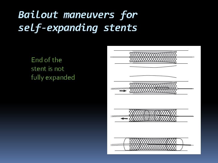 Bailout maneuvers for self-expanding stents End of the stent is not fully expanded 